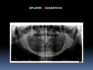 IMPLANTES ZIGOMÁTICOS
