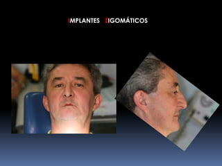 IMPLANTES ZIGOMÁTICOS
