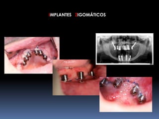 IMPLANTES ZIGOMÁTICOS