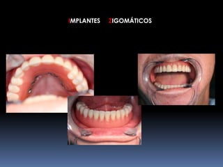 IMPLANTES ZIGOMÁTICOS