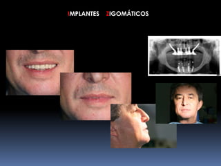 IMPLANTES ZIGOMÁTICOS