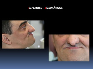 IMPLANTES ZIGOMÁTICOS