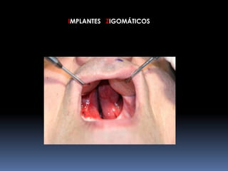 IMPLANTES ZIGOMÁTICOS