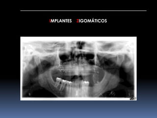 IMPLANTES ZIGOMÁTICOS