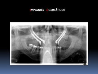 IMPLANTES ZIGOMÁTICOS