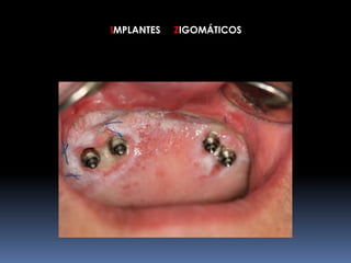 IMPLANTES ZIGOMÁTICOS