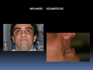 IMPLANTES ZIGOMÁTICOS