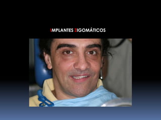 IMPLANTES ZIGOMÁTICOS