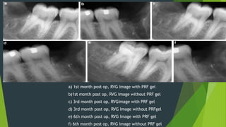 1st Rvg Bone regeneration in extraction sockets with autologous platelet | PPTX
