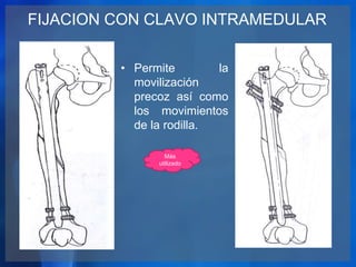 FIJACION CON CLAVO INTRAMEDULAR
• Permite la
movilización
precoz así como
los movimientos
de la rodilla.
Más
utilizado
 