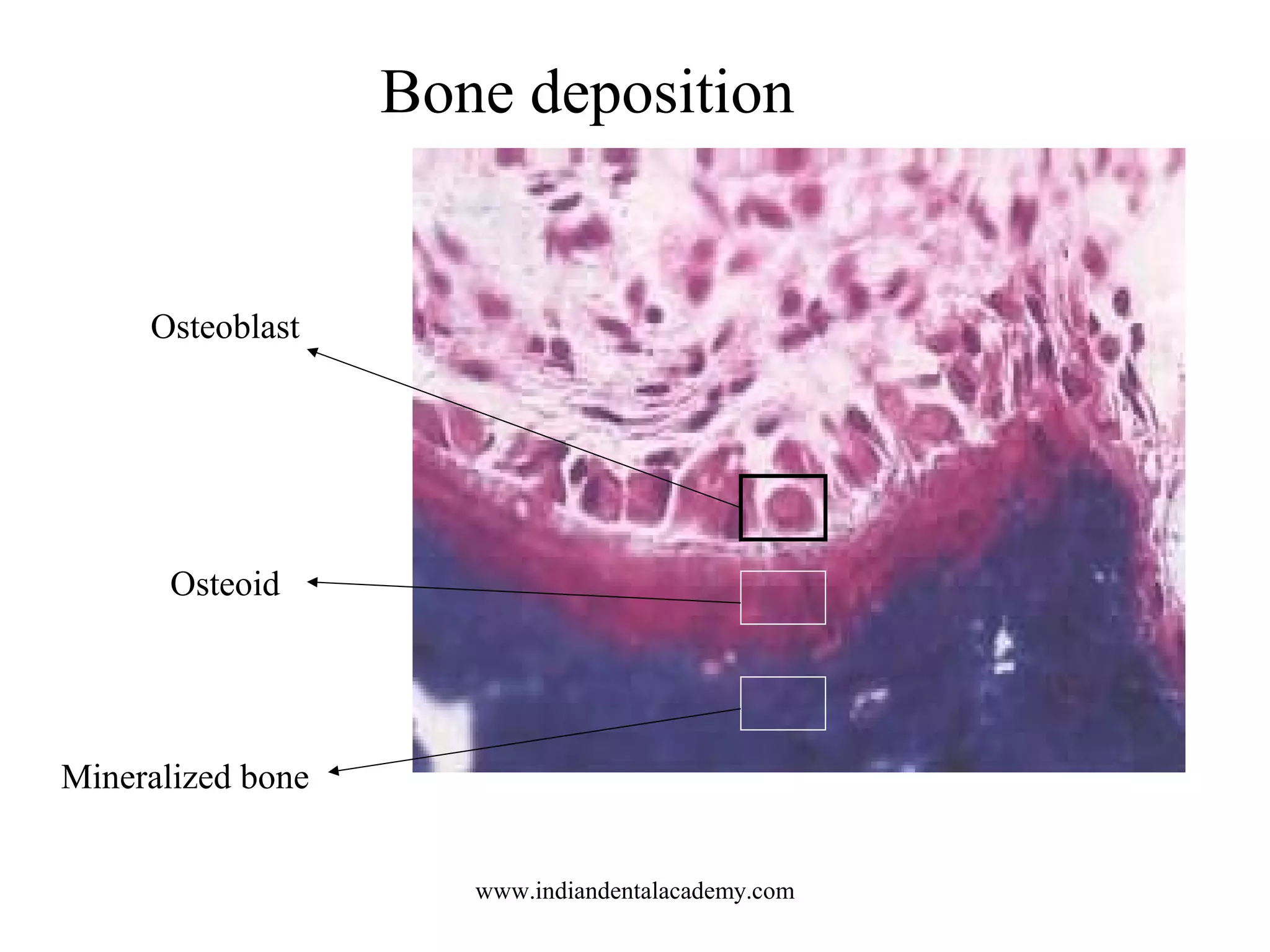 Bone deposition
Osteoblast
Osteoid
Mineralized bone
www.indiandentalacademy.com
 