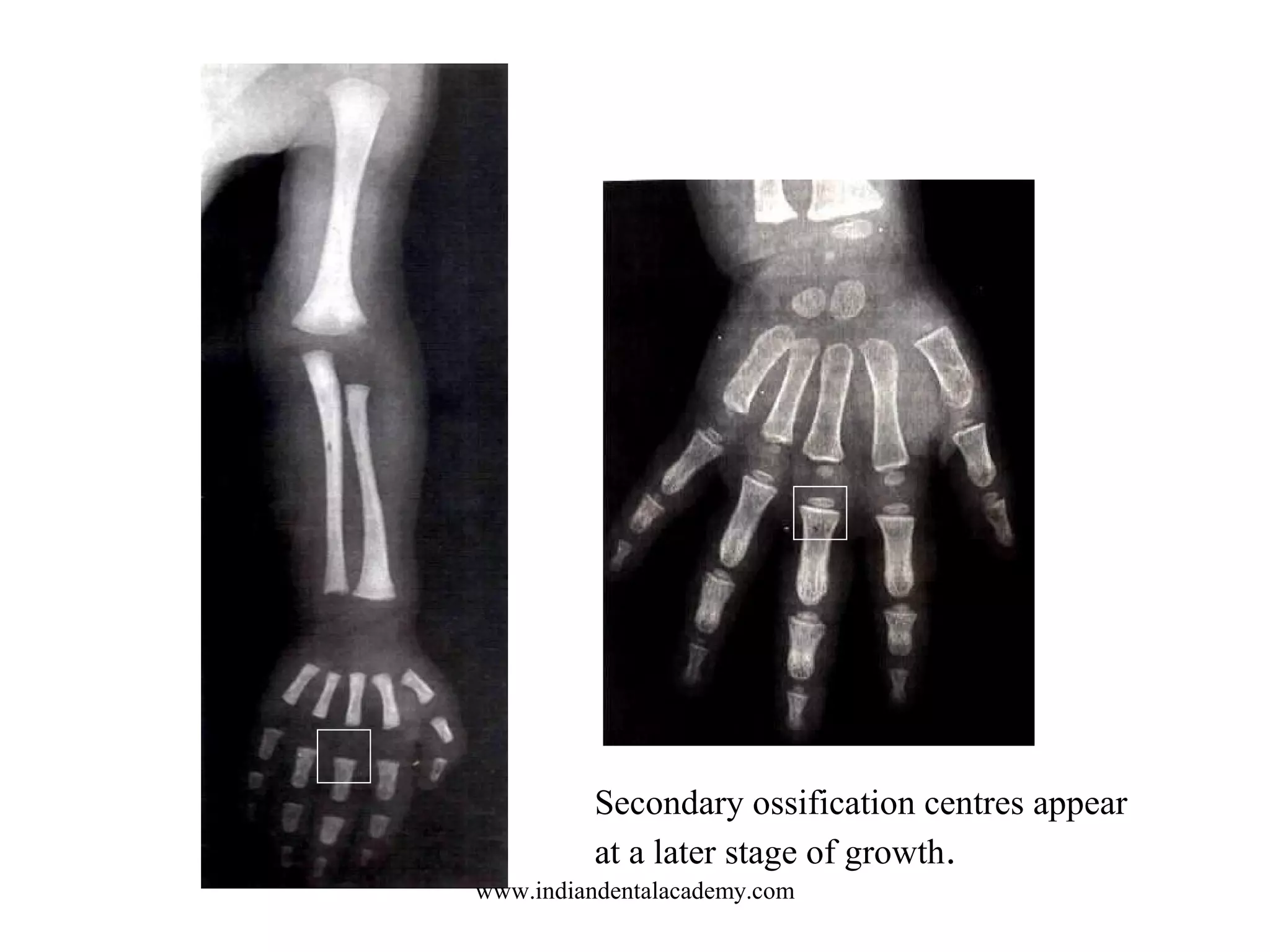 Secondary ossification centres appear
at a later stage of growth.
www.indiandentalacademy.com
 