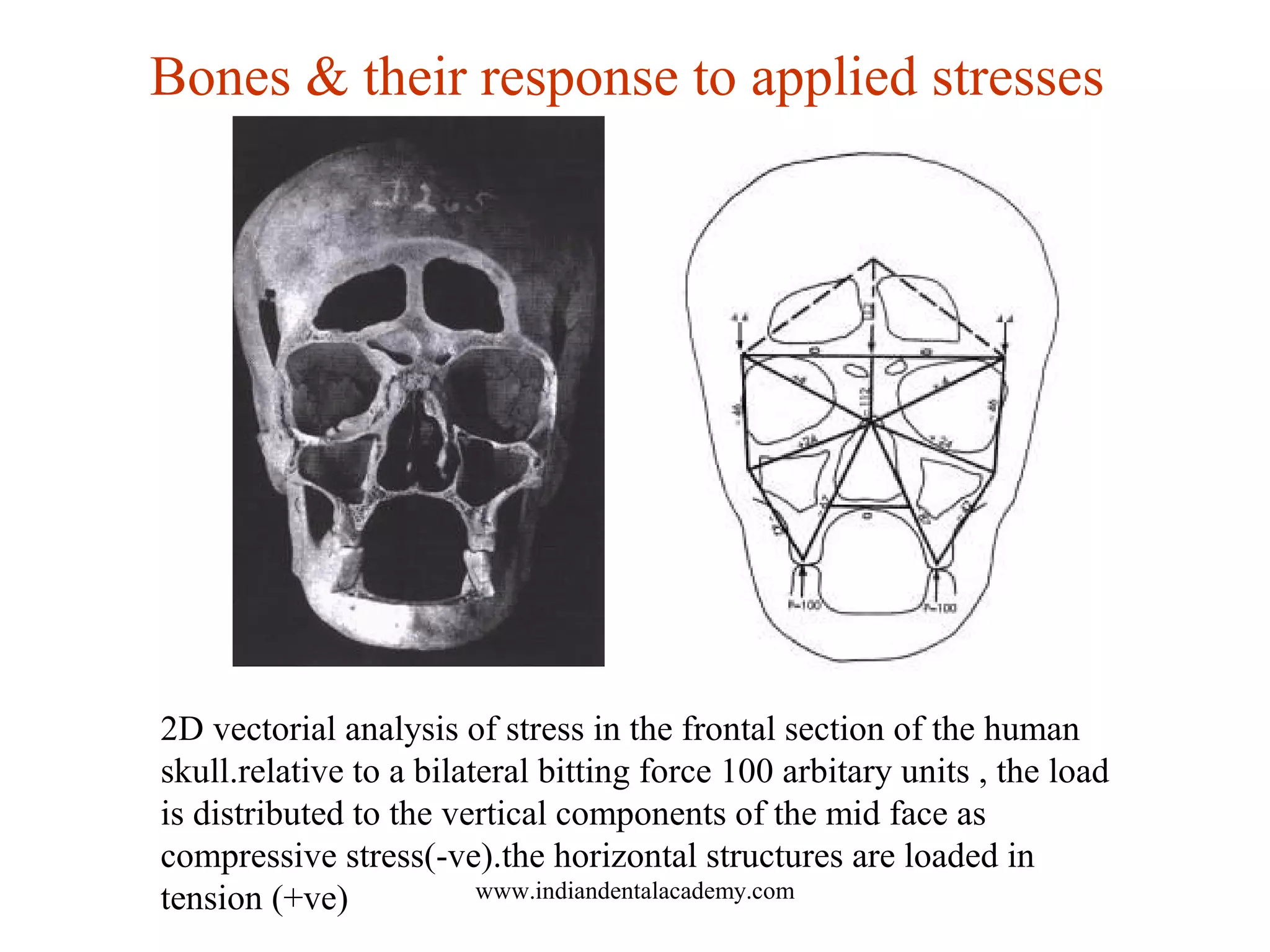 2D vectorial analysis of stress in the frontal section of the human
skull.relative to a bilateral bitting force 100 arbitary units , the load
is distributed to the vertical components of the mid face as
compressive stress(-ve).the horizontal structures are loaded in
tension (+ve)
Bones & their response to applied stresses
www.indiandentalacademy.com
 