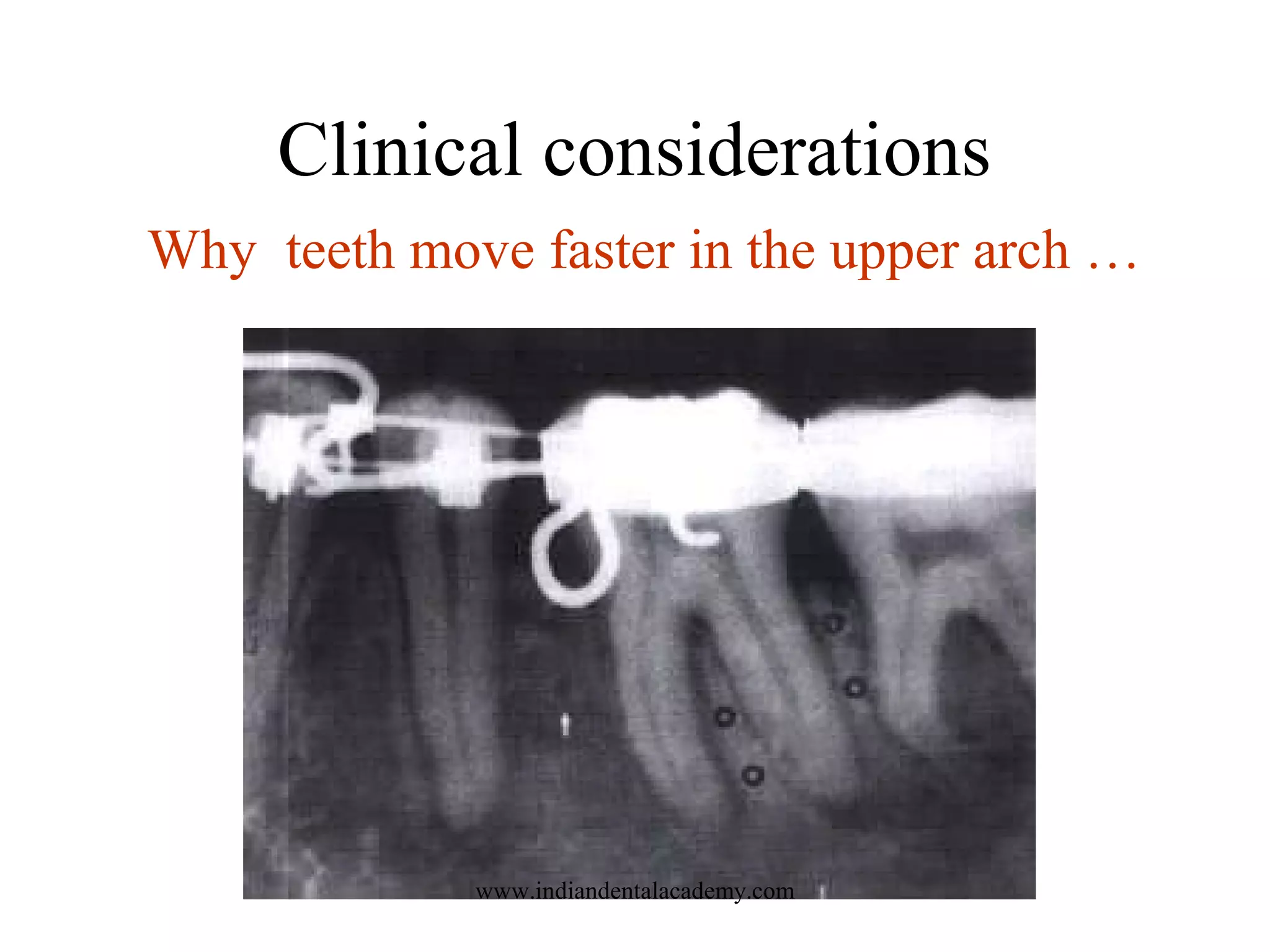 Clinical considerations
Why teeth move faster in the upper arch …
www.indiandentalacademy.com
 