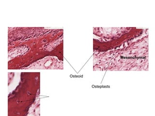 Osteoid
Osteplasts
Mesenchymal
 