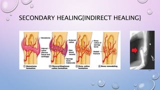 SECONDARY HEALING{INDIRECT HEALING}
 