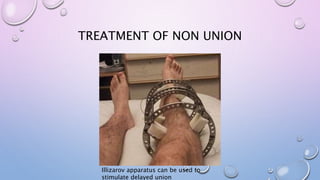 TREATMENT OF NON UNION
Illizarov apparatus can be used to
stimulate delayed union
 