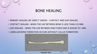 BONE HEALING
• PRIMARY HEALING {BY DIRECT UNION} – CONTACT AND GAP HEALING
• CONTACT HEALING –WHEN THE GAP BETWEEN BONE IS LESS THAN 0.01MM.
• GAP HEALING – WHEN THE GAP BETWEEN FRACTURED END IS 800UM TO 1MM.
• LAMELLAR BONE FORMATION OCCURS WITHOUT CALLUS FORMATION
Healed tibia
 