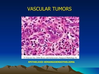 VASCULAR TUMORS EPITHELIOID HEMANGIOENDOTHELIOMA 
