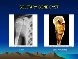 SOLITARY BONE CYST X-RAY GROSS APPEARANCE 