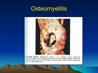 Osteomyelitis 