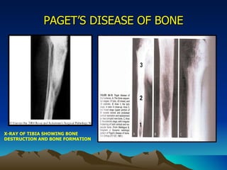 PAGET’S DISEASE OF BONE X-RAY OF TIBIA SHOWING BONE DESTRUCTION AND BONE FORMATION 