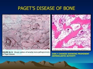 PAGET’S DISEASE OF BONE EARLY CHANGES SHOWING PROMINENT  OSTEOCLASTIC ACTIVITY 