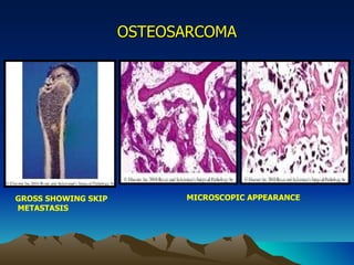 OSTEOSARCOMA GROSS SHOWING SKIP METASTASIS MICROSCOPIC APPEARANCE 