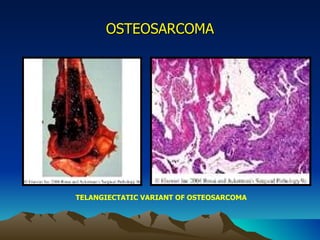 OSTEOSARCOMA TELANGIECTATIC VARIANT OF OSTEOSARCOMA 