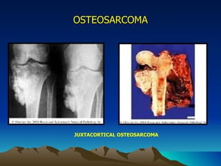 OSTEOSARCOMA JUXTACORTICAL OSTEOSARCOMA 