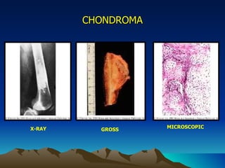 CHONDROMA X-RAY GROSS MICROSCOPIC 