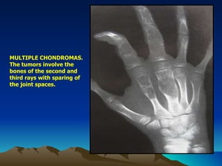 MULTIPLE CHONDROMAS. The tumors involve the bones of the second and third rays with sparing of the joint spaces. 
