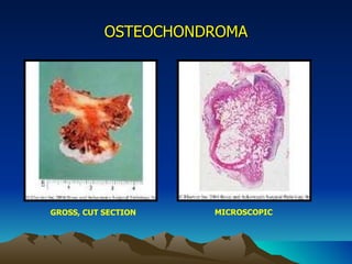 OSTEOCHONDROMA GROSS, CUT SECTION MICROSCOPIC 