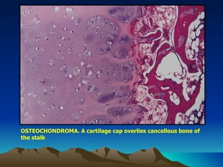 OSTEOCHONDROMA. A cartilage cap overlies cancellous bone of the stalk 