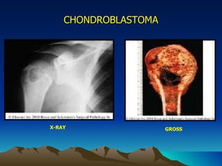 CHONDROBLASTOMA X-RAY GROSS 
