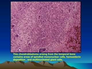 This chondroblastoma arising from the temporal bone contains areas of spindled mononuclear cells, hemosiderin deposition , and multinucleated giant cells. 