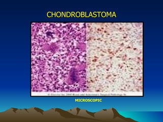 CHONDROBLASTOMA MICROSCOPIC 