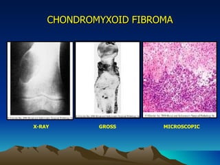 CHONDROMYXOID FIBROMA X-RAY GROSS MICROSCOPIC 