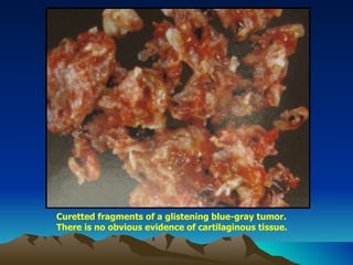 Curetted fragments of a glistening blue-gray tumor. There is no obvious evidence of cartilaginous tissue. 