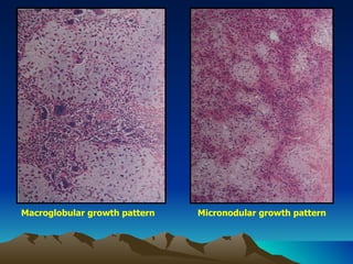 Macroglobular growth pattern Micronodular growth pattern 