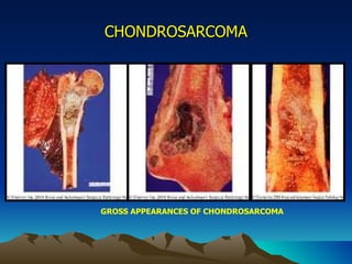 CHONDROSARCOMA GROSS APPEARANCES OF CHONDROSARCOMA 