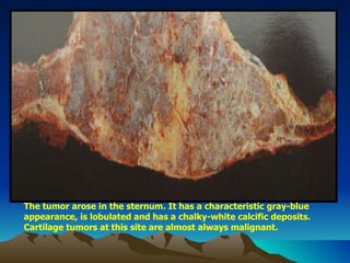 The tumor arose in the sternum. It has a characteristic gray-blue appearance, is lobulated and has a chalky-white calcific deposits. Cartilage tumors at this site are almost always malignant. 