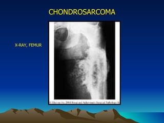 CHONDROSARCOMA X-RAY, FEMUR 