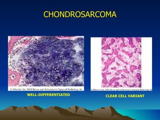 CHONDROSARCOMA WELL-DIFFERENTIATED  CLEAR CELL VARIANT 