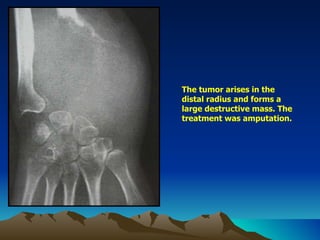 The tumor arises in the distal radius and forms a large destructive mass. The treatment was amputation. 