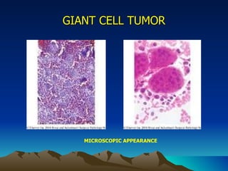 GIANT CELL TUMOR MICROSCOPIC APPEARANCE 