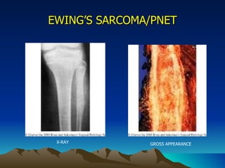 EWING’S SARCOMA/PNET X-RAY GROSS APPEARANCE 