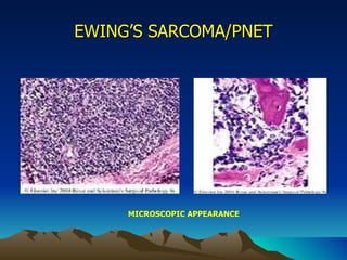 EWING’S SARCOMA/PNET MICROSCOPIC APPEARANCE 