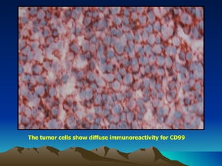 The tumor cells show diffuse immunoreactivity for CD99 