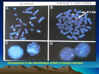 Fluorescence in situ hybridization (FISH) in Ewing’s sarcoma 
